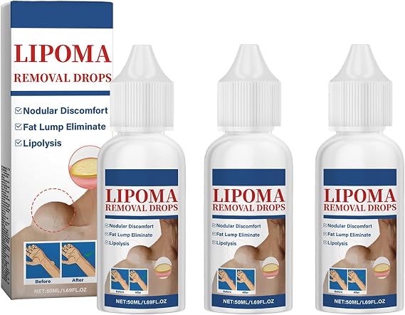 Herbal Lipoma Removal Drops,Lipoma Removal,Lipoma Removal Cream,Creating Perfect Skin(3PCS)